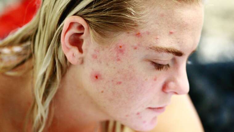 Ômega 3 para acne: como o Ômega 3 pode tratar a acne.