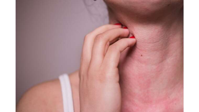 Ômega 3 pode causar alergia? Saiba quais são os sintomas